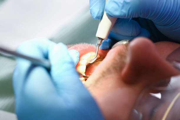 Best Emergency Root Canal Treatment in Keys, OK