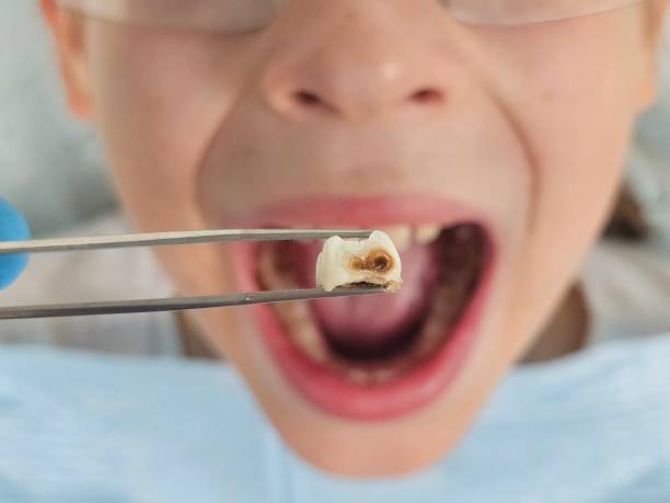 Best Emergency Dentist for Lost Fillings or Crowns in Keys, OK